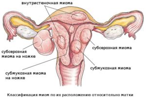 Менопаузальный период и миома Менопаузальный период и миома