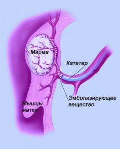 Занятия спортом при миоме матки Занятия спортом при миоме матки