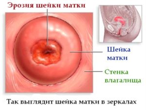 Лекарство от эрозии шейки матки