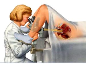 Кольпоскопия шейки матки при эрозии