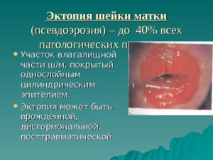 Лекарство от эрозии шейки матки