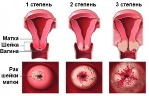Какие выделения при климаксе считаются нормальными Какие выделения при климаксе считаются нормальными