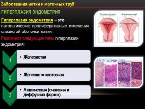 Железо кистозная гиперплазия эндометрия Железо кистозная гиперплазия эндометрия